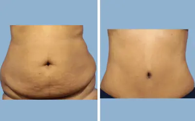 Before and After